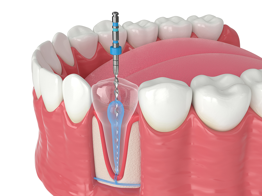 Understanding Endodontics: The Key to Saving Your Natural Teeth in Amarillo, TX